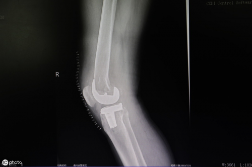 肺癌早期病人补硒有效吗(肺癌补硒有用吗)-硒宝网