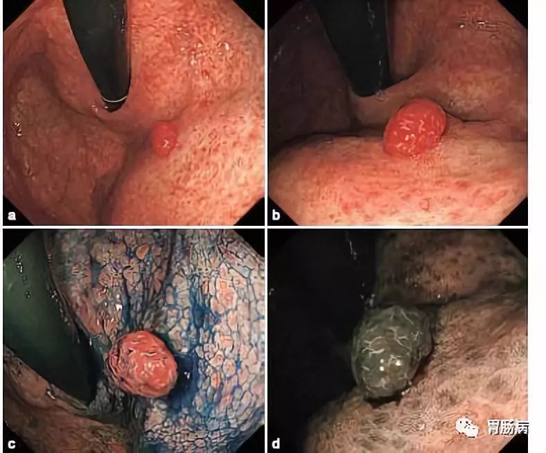胃息肉手术后可以补硒吗(胃手术补息肉硒可以后用吗)-硒宝网