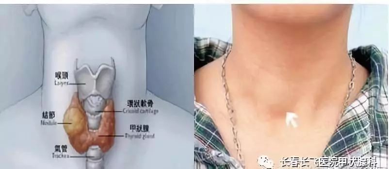 甲状腺疾病一定要补硒吗（疾病补甲状腺硒要多久）-硒宝网