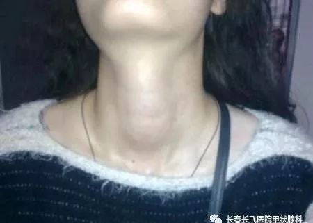 甲状腺疾病一定要补硒吗（疾病补甲状腺硒要多久）-硒宝网