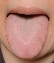 补硒可以治疗甲状腺炎吗(甲状腺炎吃硒)-硒宝网