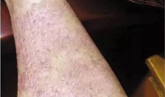 肺结节手术后可以补硒吗（肺结节手术后可以吃钙片吗）-硒宝网