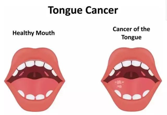 肺结节手术后可以补硒吗（肺结节手术后可以吃钙片吗）-硒宝网