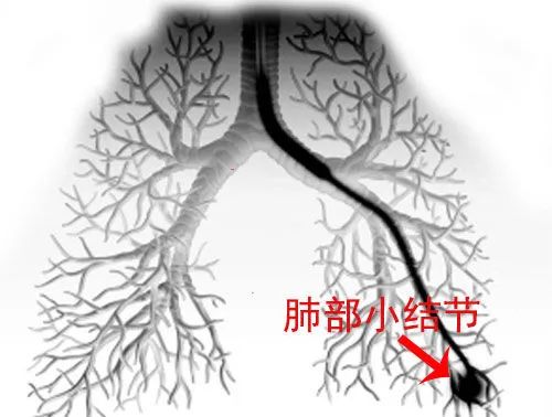 肺部有有结节可以补硒吗（肺结节可以吃硒酵母吗）-硒宝网