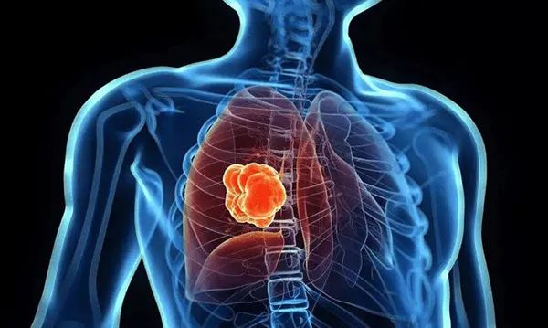 肺部有有结节可以补硒吗（肺结节可以吃硒酵母片吗）-硒宝网