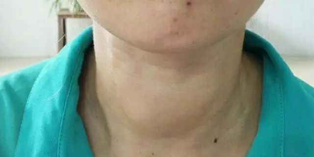 甲减要吃哪些补硒药好呢(药补吃好硒要甲减吃多久)-硒宝网