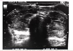 甲减要吃哪些补硒药好呢(药补吃好硒要甲减吃多久)-硒宝网