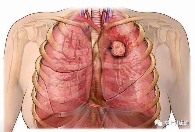 肺癌补硒元素吃多少克好（肺癌补硒吃什么药）-硒宝网