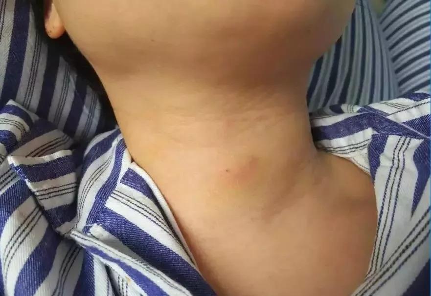 甲状腺癌补硒有什么帮助(甲状腺癌补硒)-硒宝网