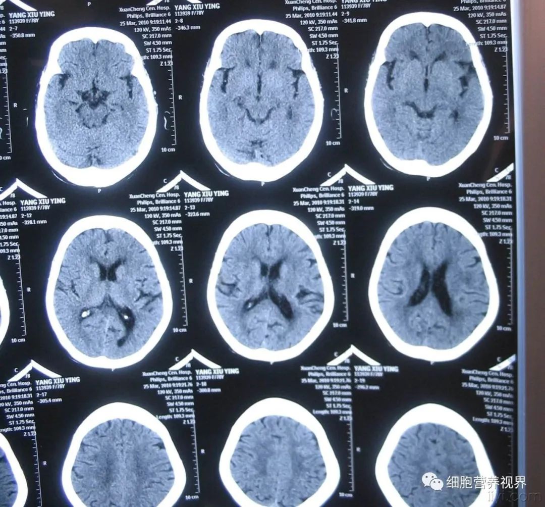 脑梗的人补硒有什么好处(硒与脑梗塞的关系是什么)-硒宝网