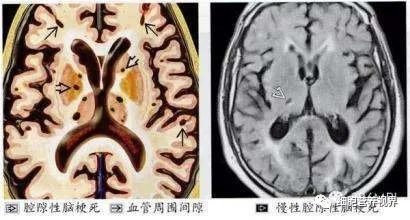 脑梗的人补硒有什么好处(硒与脑梗塞的关系是什么)-硒宝网