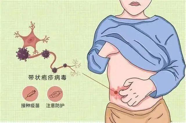 得过带状疱疹需要补硒吗（带状疱疹要补充维生素吗）-硒宝网