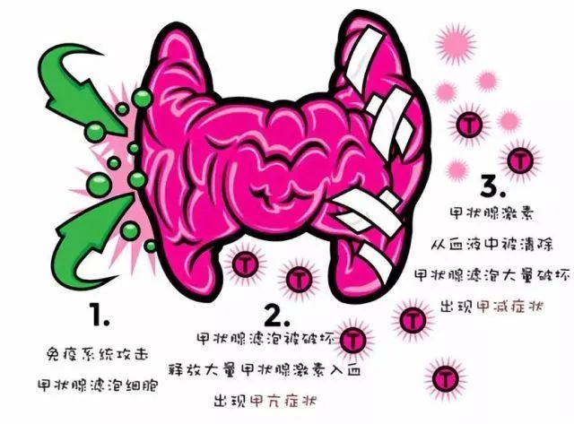 补硒可以调节甲状腺炎吗(补硒可以治疗甲状腺炎吗)-硒宝网