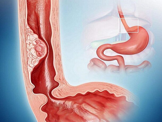 食管癌治疗后可以补硒吗(硒与食管癌的作用)-硒宝网