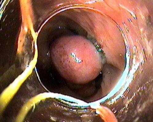 食管癌治疗后可以补硒吗(硒与食管癌的作用)-硒宝网