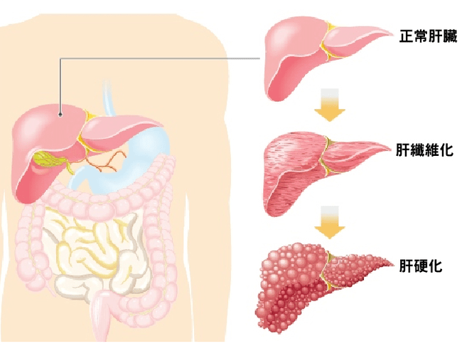 补硒多了会出现肝襄肿吗（肝襄肿吃什么东西有好处）-硒宝网