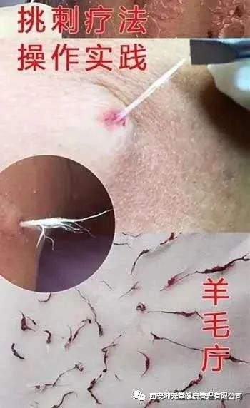 羊毛疔是不是缺硒怎样补（羊缺硒用什么药）-硒宝网