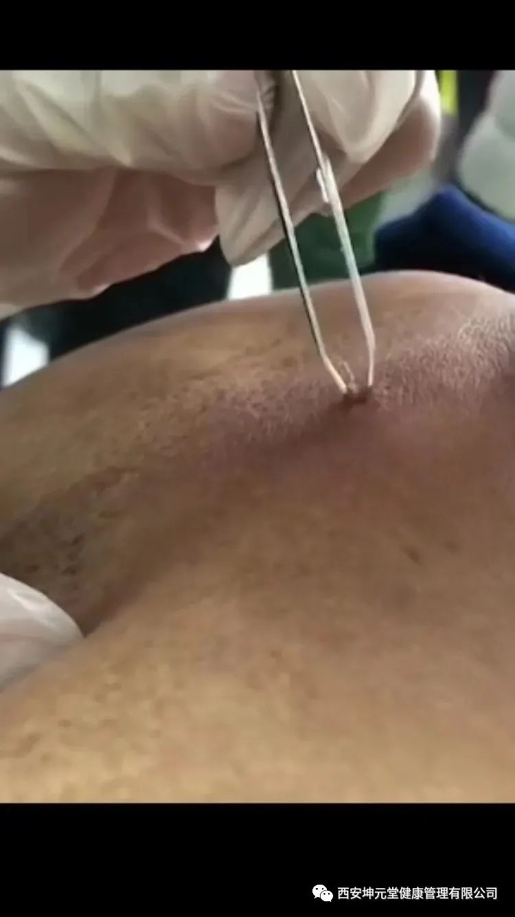 羊毛疔是不是缺硒怎样补（羊缺硒用什么药）-硒宝网