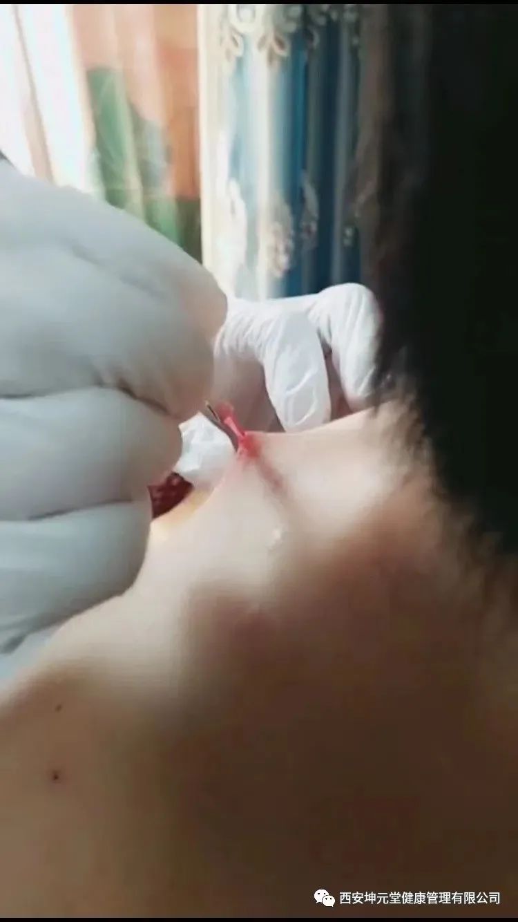 羊毛疔是不是缺硒怎样补（羊缺硒用什么药）-硒宝网