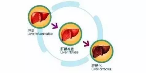 肝硬化病人一天补多少硒(肝硬化病人补一天硒可以吗)-硒宝网