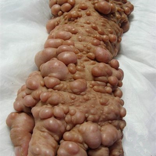 纤维瘤手术后可以补硒吗（纤维瘤手术后可以吃西红柿吗）-硒宝网