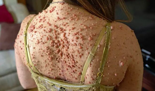 纤维瘤手术后可以补硒吗（纤维瘤手术后可以吃西红柿吗）-硒宝网