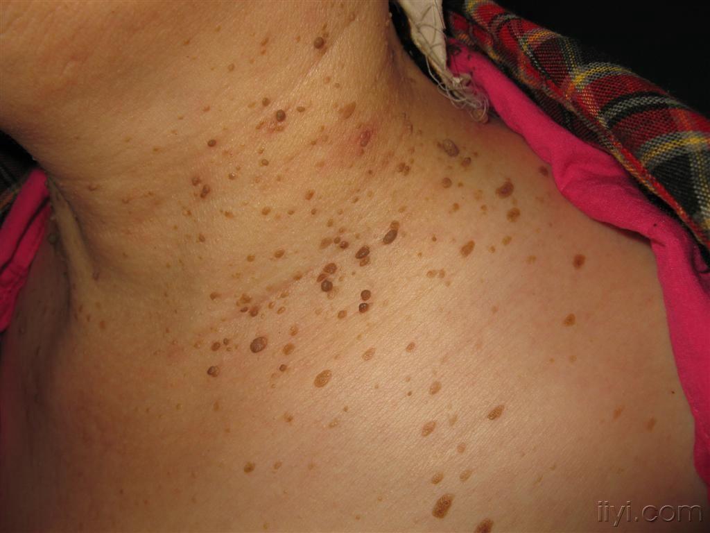 纤维瘤手术后可以补硒吗（纤维瘤手术后可以吃西红柿吗）-硒宝网