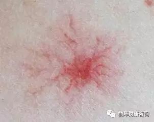 补硒会导致雄性激素过盛（雄性激素补多了会产生什么后果）-硒宝网