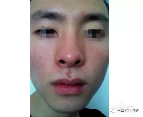 补硒会导致雄性激素过盛（雄性激素补多了会产生什么后果）-硒宝网