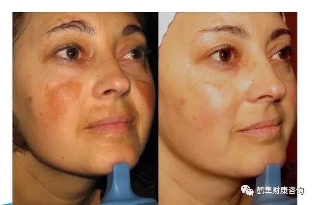 补硒会导致雄性激素过盛（雄性激素补多了会产生什么后果）-硒宝网