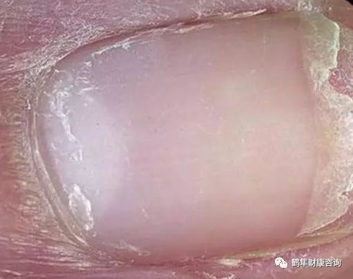 补硒会导致雄性激素过盛（雄性激素补多了会产生什么后果）-硒宝网