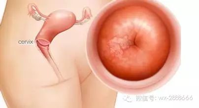 宫颈癌病人补硒吃什么好(硒片对宫颈癌)-硒宝网