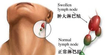 补硒能治疗淋巴结肿大么（硒对淋巴结的效果）-硒宝网