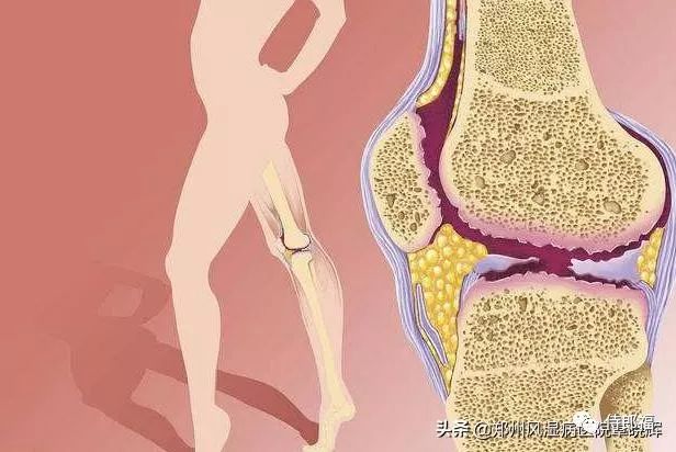 补硒能使风湿病人加重吗(类风湿患者能吃硒酵母片吗)-硒宝网