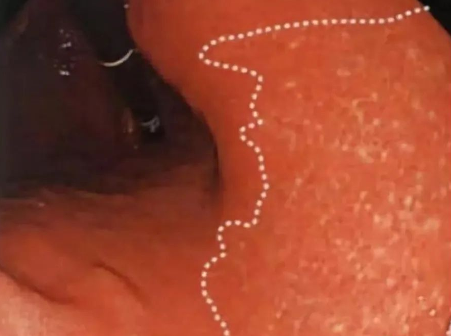 萎缩性胃炎怎样补硒的呢(萎缩性胃炎硒酵母片)-硒宝网