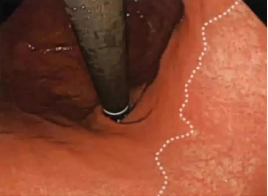 萎缩性胃炎怎样补硒的呢(萎缩性胃炎硒酵母片)-硒宝网