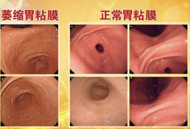 萎缩性胃炎怎样补硒的呢(萎缩性胃炎要吃多少硒)-硒宝网