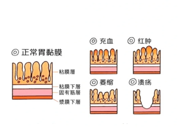萎缩性胃炎怎样补硒的呢(萎缩性胃炎要吃多少硒)-硒宝网