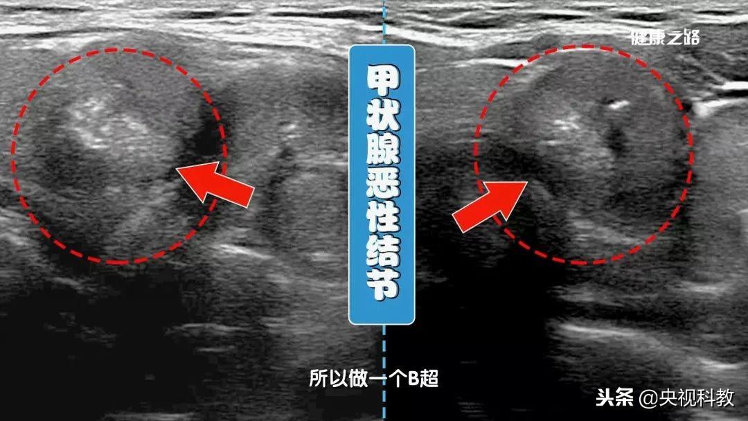 甲亢的人为啥要补硒呢呢（甲亢补硒）-硒宝网