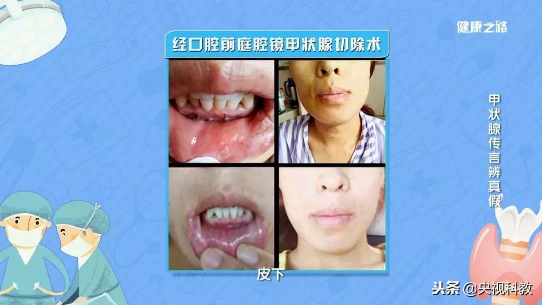 甲亢的人为啥要补硒呢呢（甲亢补硒）-硒宝网