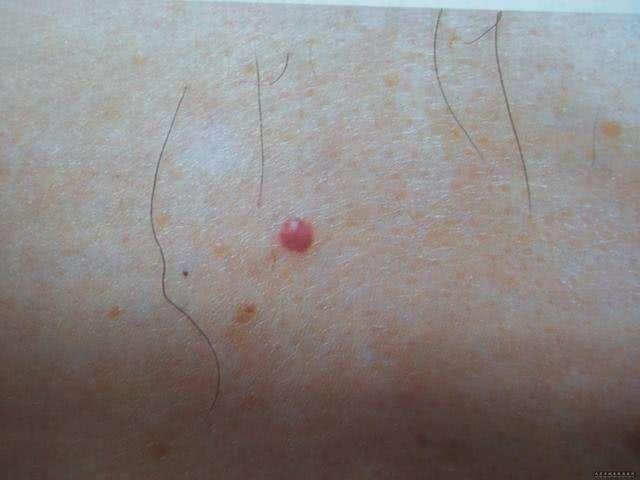 癌细胞扩散到肝能补硒吗（肝癌细胞扩散了还有救吗）-硒宝网