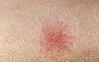 补硒后皮肤特别痒怎么办(为什么补硒会皮肤痒)-硒宝网