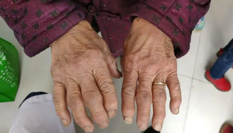 补硒后皮肤特别痒怎么办(补硒对皮肤病的治疗)-硒宝网