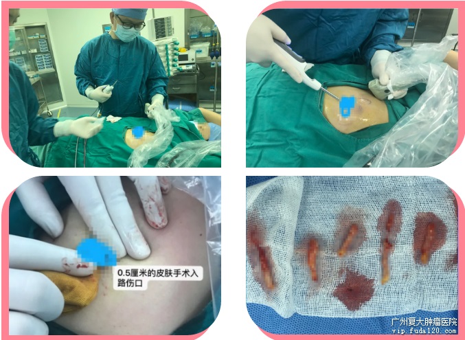 补硒防乳腺癌吗能治好吗(乳腺癌能大补吗)-硒宝网