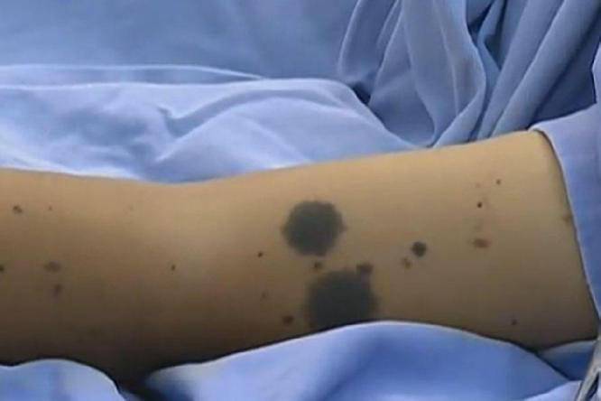 黑色素瘤患者可以补硒吗（硒对黑色素瘤有没有效）-硒宝网