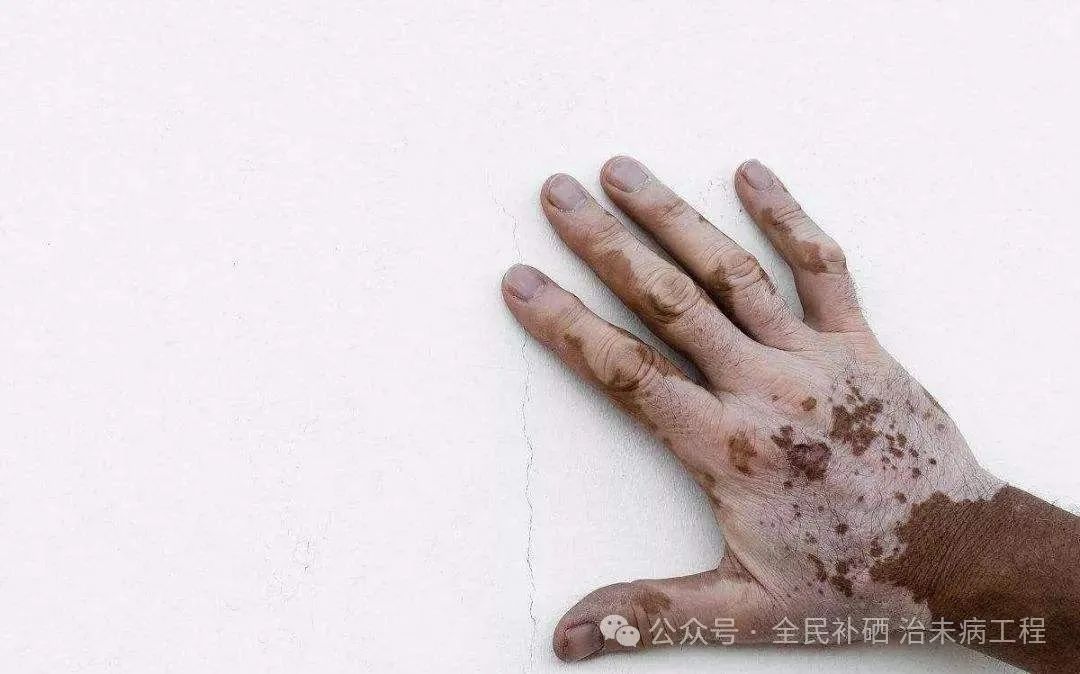 甲亢用不用补硒的维生素（用维生素补甲亢硒可以吗）-硒宝网