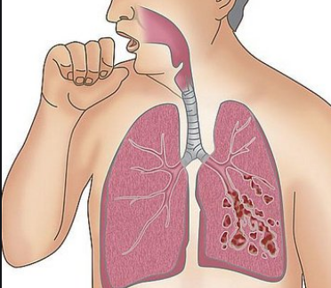 支气管炎哮喘可以补硒吗(支气管炎哮喘病可以吃补肺丸吗)-硒宝网