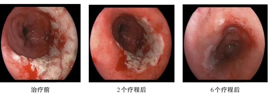 直肠癌能补硒吗中医治疗（中医能补治疗直肠癌硒吗）-硒宝网