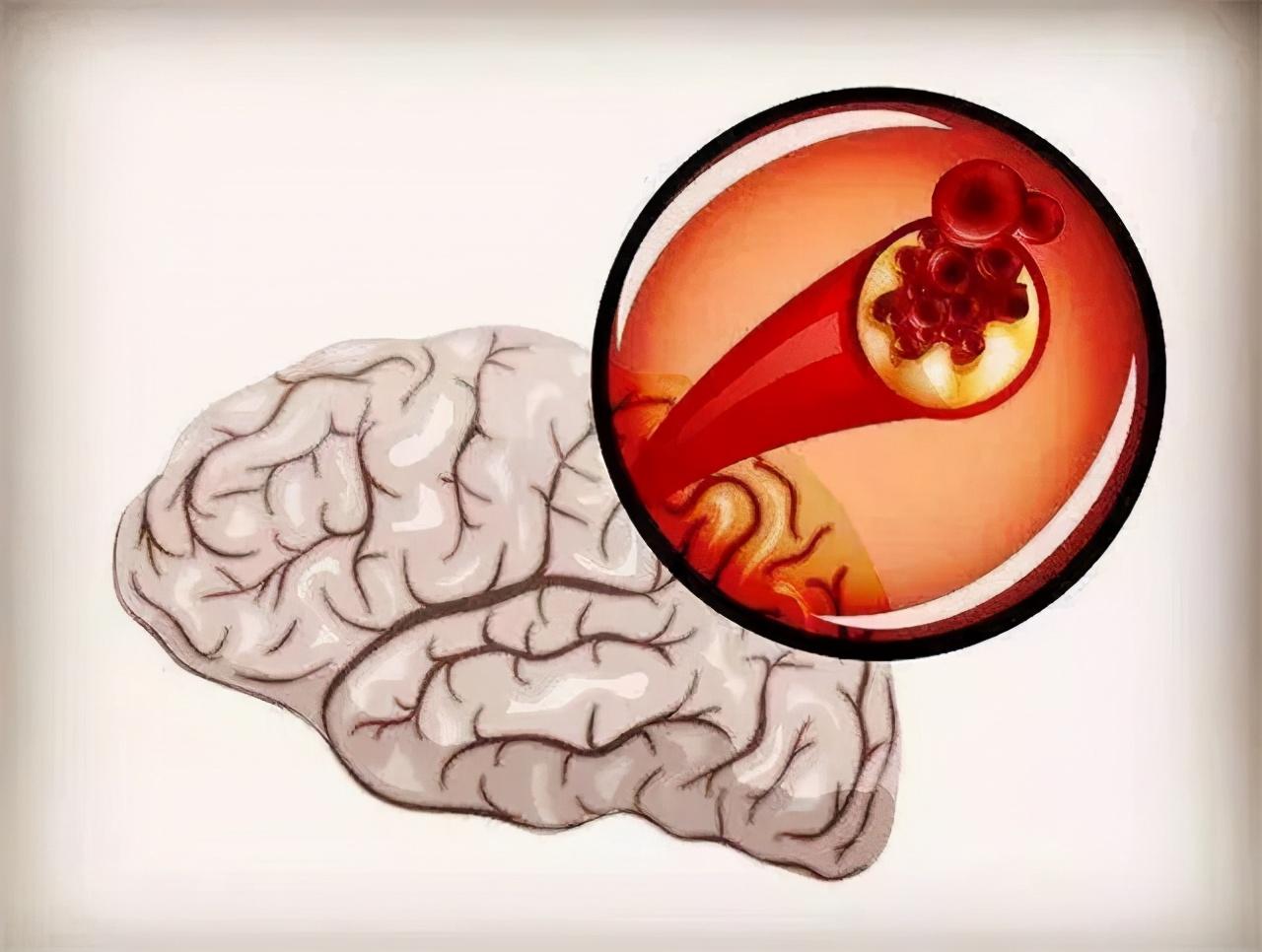 得了脑梗能补维生素硒吗(维生素对脑梗起作用吗)-硒宝网