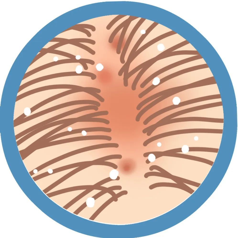 二硫化硒去屑产品有哪些(硫化去屑产品硒有什么作用)-硒宝网